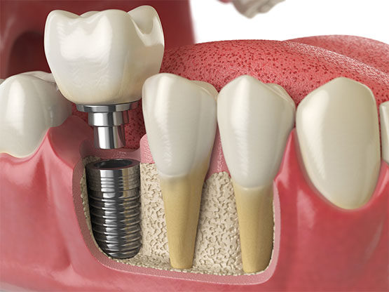 implantes dentales en guadalajara