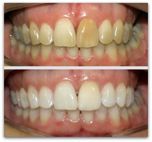 blanqueamiento dental en guadalajara