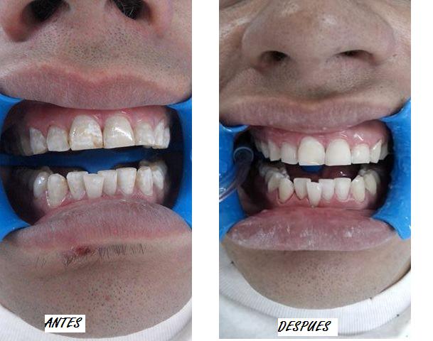 blanqueamiento dental en guadalajara
