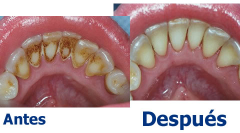 implantes dentales en guadalajara