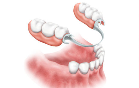 rehabilitacion de protesis en guadalajara