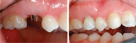 rehabilitacion de protesis en guadalajara